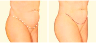 Abdominoplasty Tummy Tuck Surgery With Guy Sterne